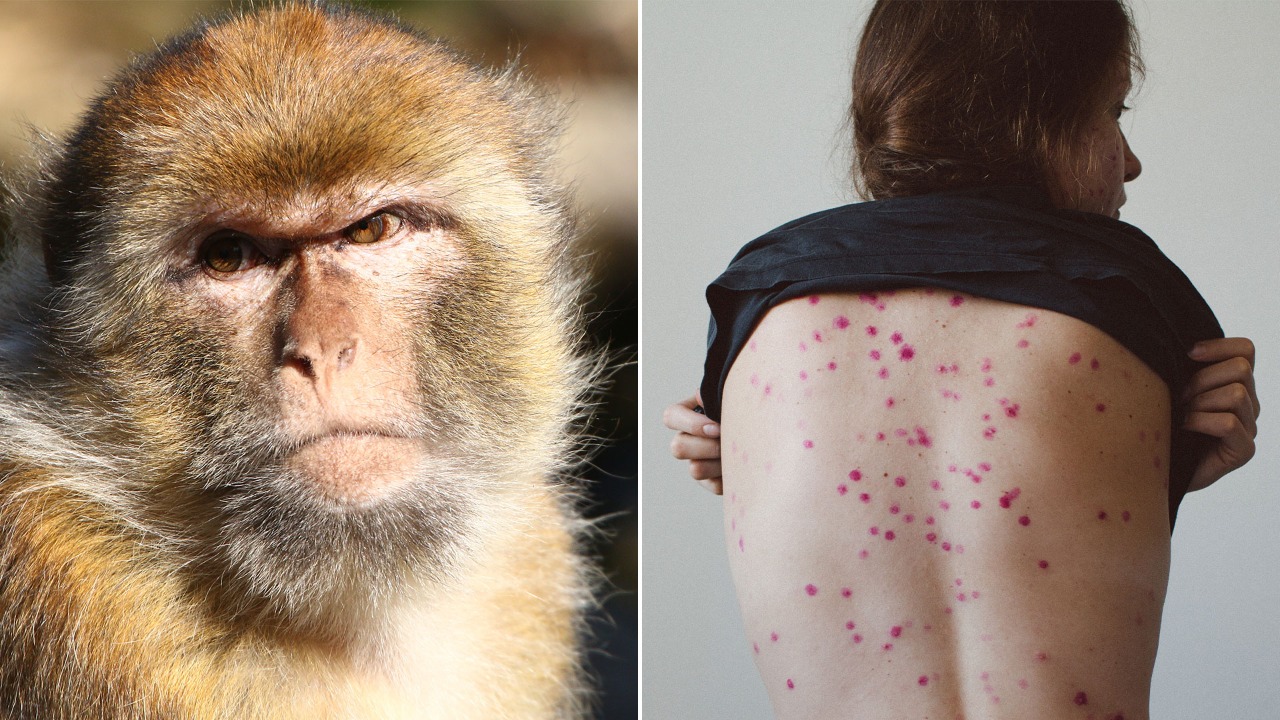 Viruela del mono: cómo se transmite, cuáles son los síntomas y qué hacer para evitar contagiarse